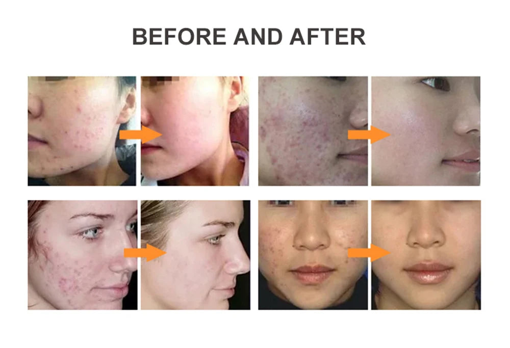 6-in-1 High Frequency Skin Therapy Wand